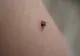 Cum ne putem proteja împotriva căpușelor și a bolilor transmite de acestea